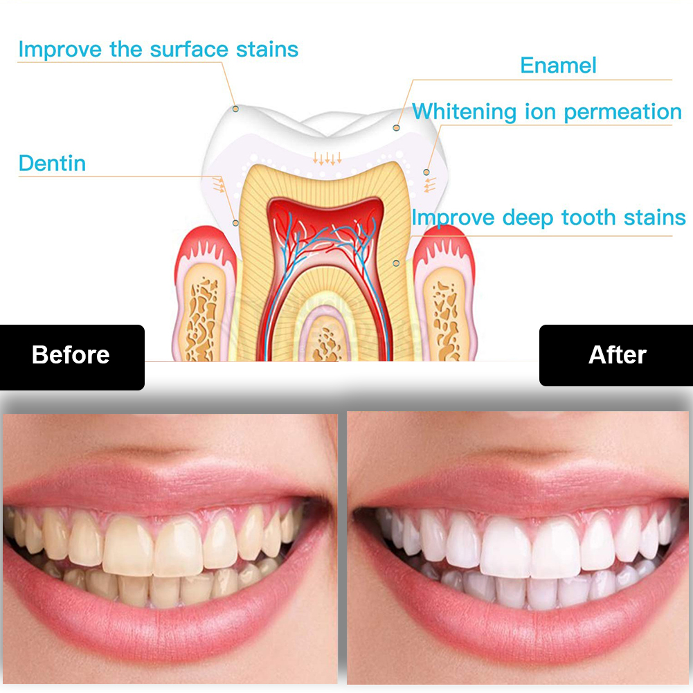 Dental Teeth Whitening Kit Min - مراجعة Teeth Whitening Bleaching Kit وسعره