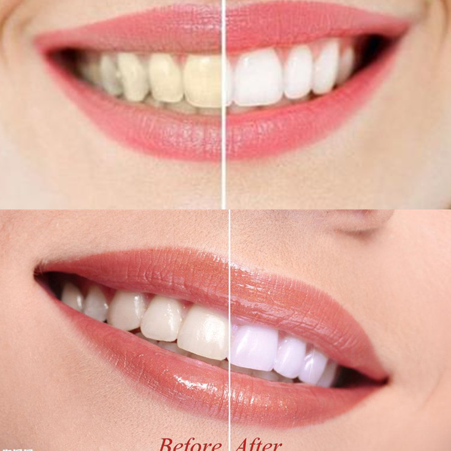 Bamboo Charcoal Teeth Tooth De - مراجعة Teeth Whitening Near Me وسعره