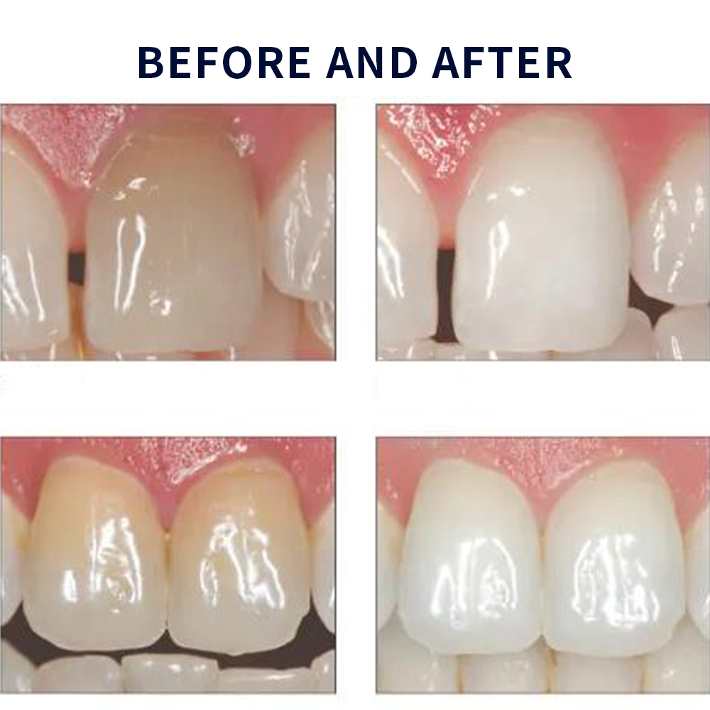 Opalescence Whitening 20% PF 2 - مراجعة Teeth Whitening Bleaching Kit وسعره