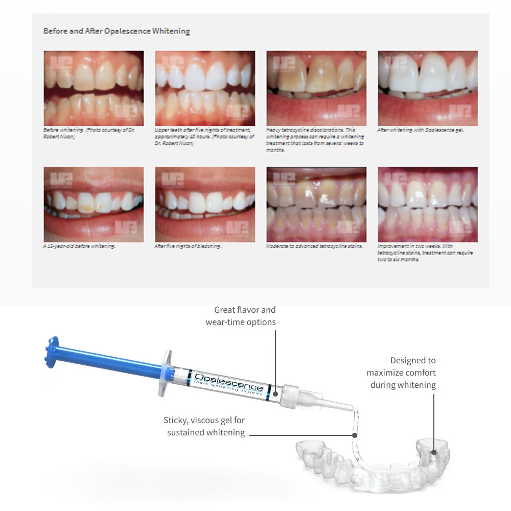 Opalescence Whitening 20% PF 2 - مراجعة Teeth Whitening Bleaching Kit وسعره