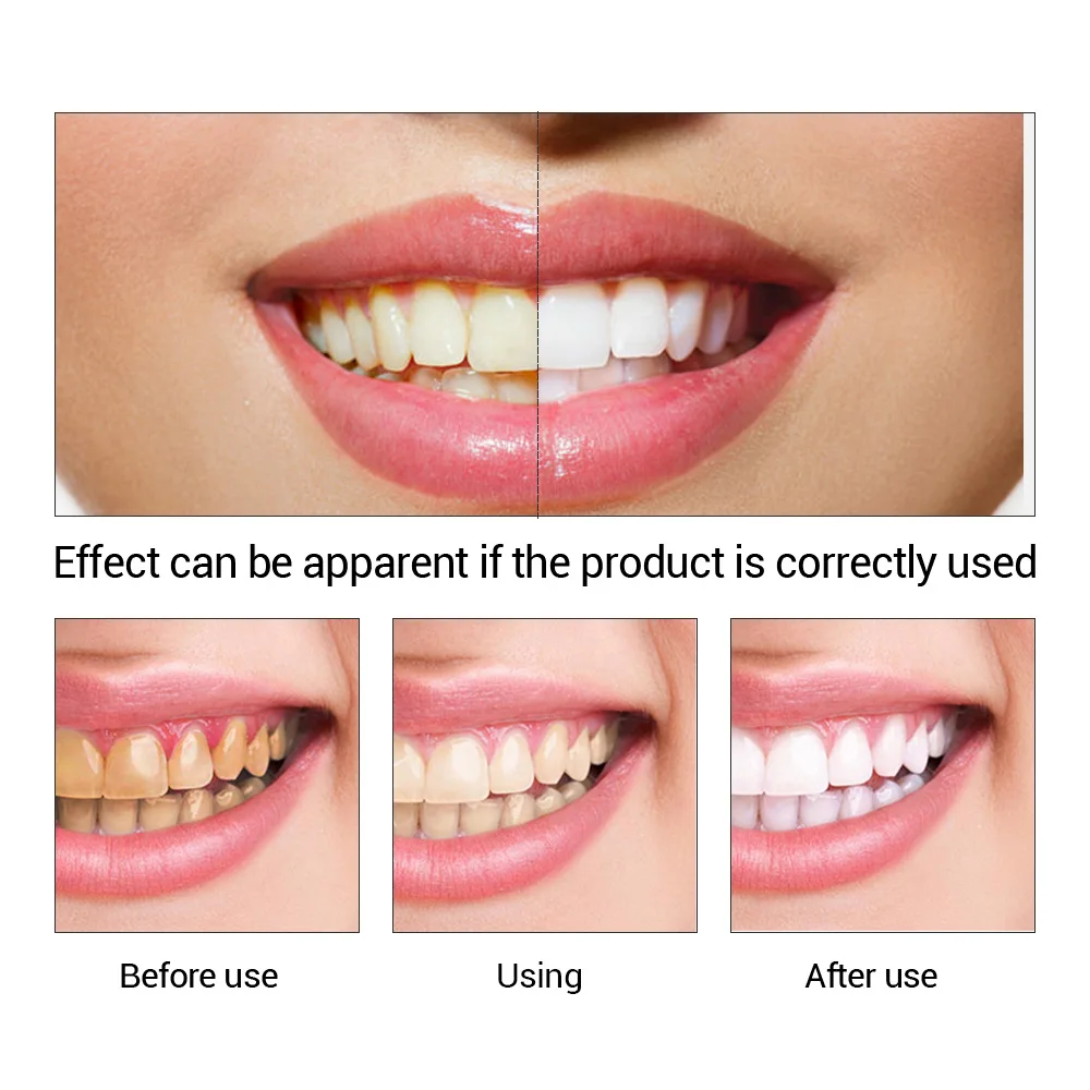 FTEENPLY Teeth Whitening Essen - مراجعة Teeth Whitening Paste وسعره