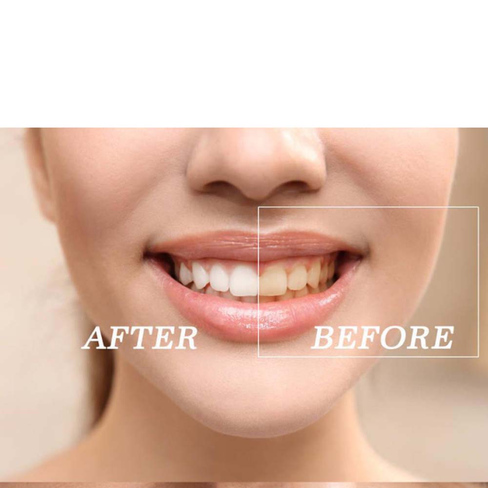 Top Quality Peroxide Teeth Whi - مراجعة Teeth Whitening Bleaching Kit وسعره