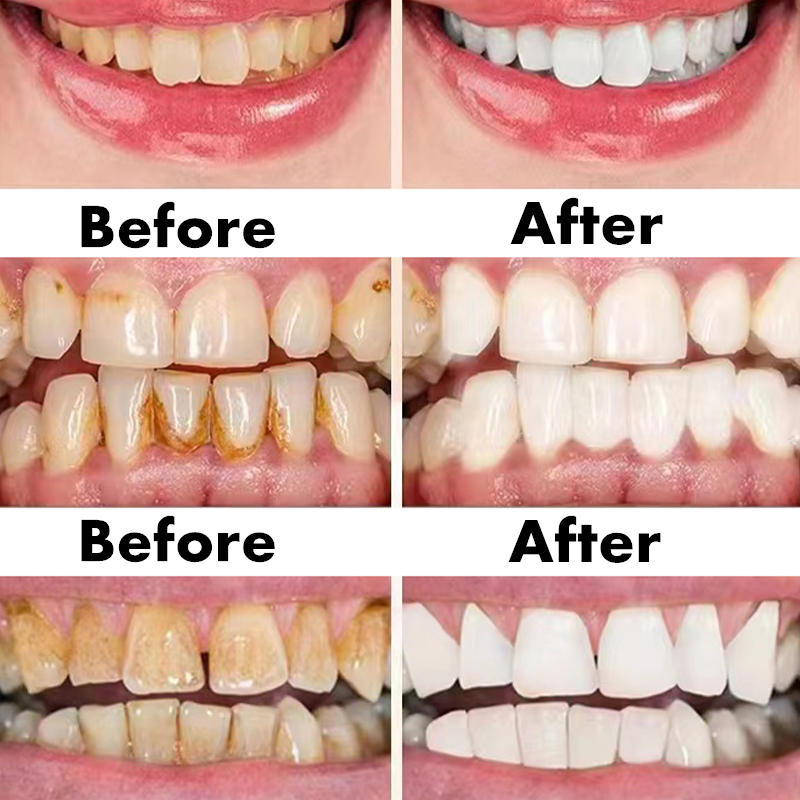 Teeth Whitening Pen Dental Ess - مراجعة Teeth Whitening Bleaching Kit وسعره