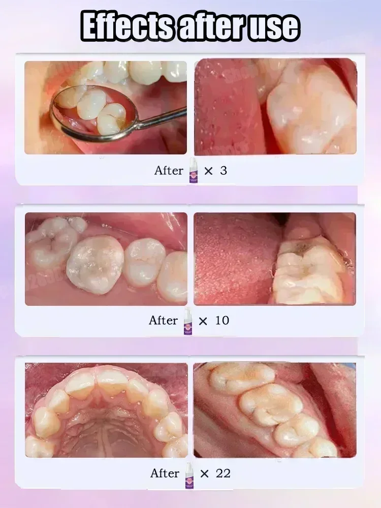 Teeth Cleaning Toothpaste Remo - مراجعة Teeth Whitening Toothpaste وسعره